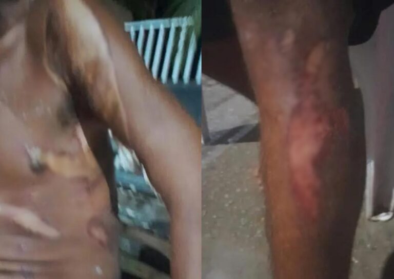 Morador de rua é atacado e queimado com ácido; ele fica gravemente ferido