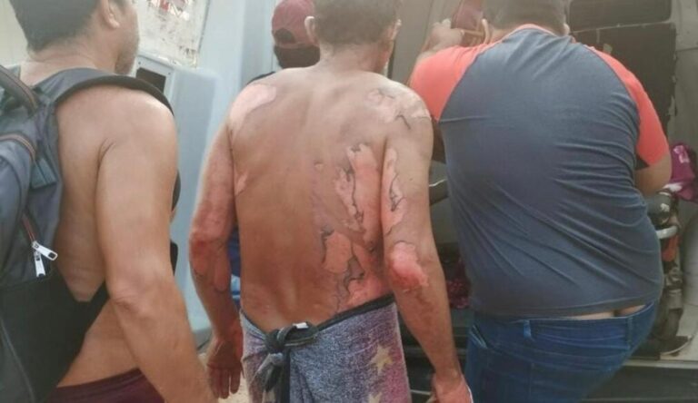 Homem sofre graves queimaduras após explosão de roçadeira em Cruzeiro do Sul