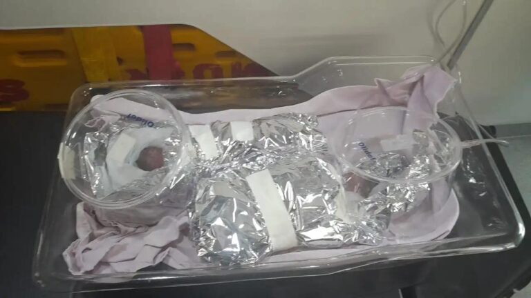 Gêmeas indígenas prematuras resgatadas em Manoel Urbano não resistem e morrem em Rio Branco