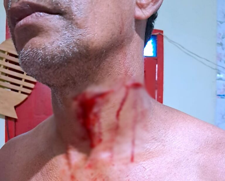 Homem tem pescoço cortado por linha com cerol em Epitaciolândia