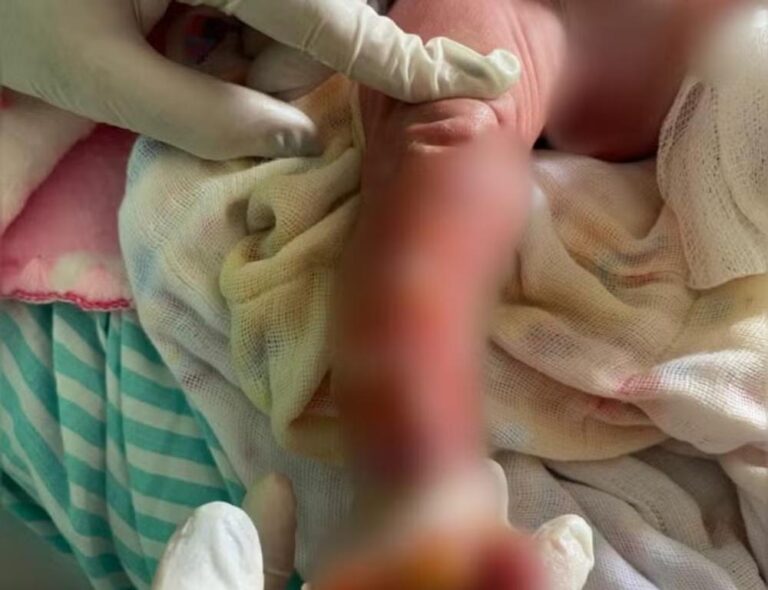 Bebê que sofreu queimaduras em maternidade do Acre deve passar por cirurgia em hospital MG nesta quarta