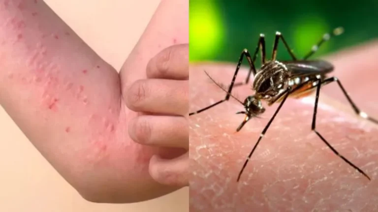 Acre registra 1.207 notificações de Chikungunya até agosto de 2025