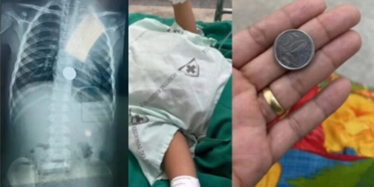 Menino de 5 anos engole moeda e vai parar no hospital para retirada do objeto no Acre